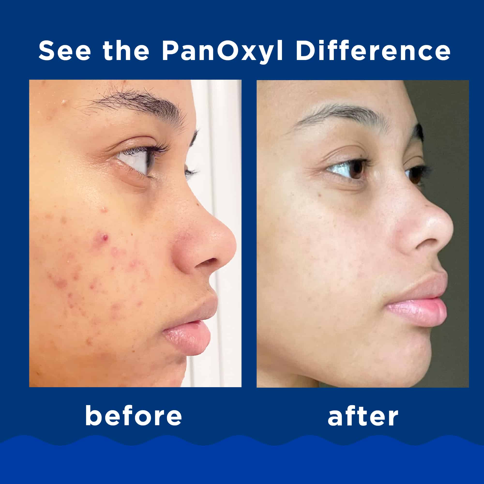 Panoxyl Foaming Acne Wash Maximum Strength 10% Benzoyl Peroxide